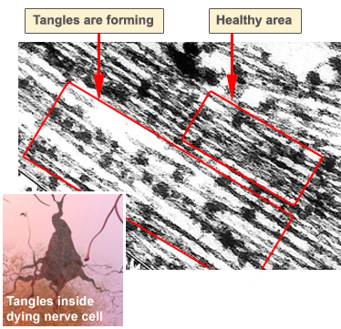 Tangle detail (under electron micrograph)