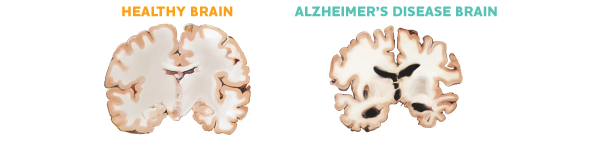 Healthy Brain vs. Alzheimer's Disease Brain