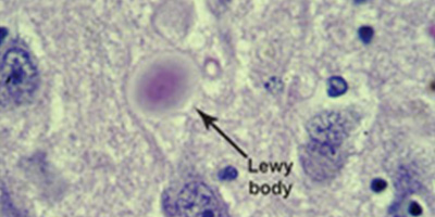 Image of Lewy body in brain tissue