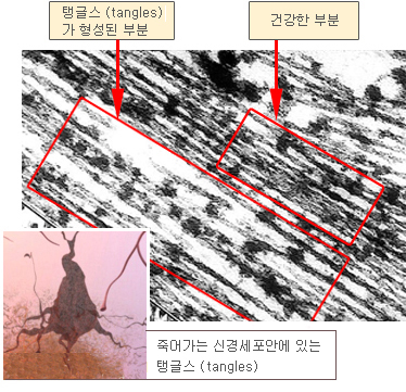 Tangle detail (under electron micrograph)