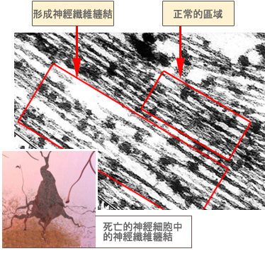 Tangle detail (under electron micrograph)