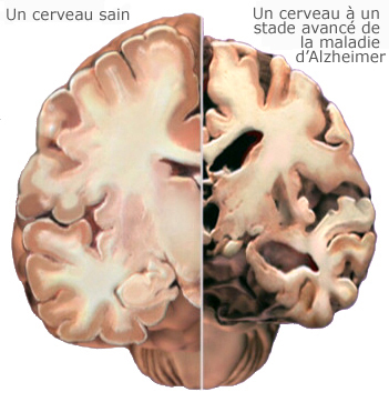 Cerveau sain vs cerveau atteint d'alzheimer | Association Alzheimer