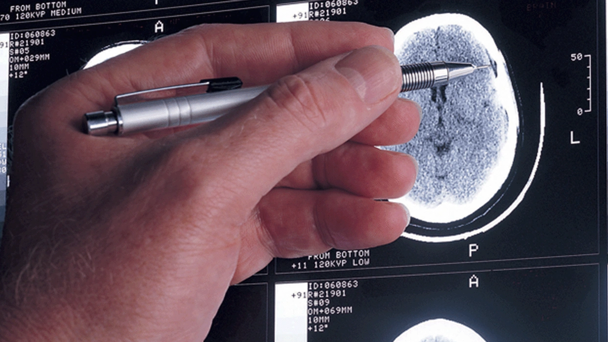 Lecanemab Resources for Health Care Professionals