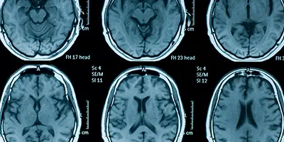 MRI scans showing cross-sectional views of the human brain, used in Alzheimer’s research to study structural changes and disease progression.
