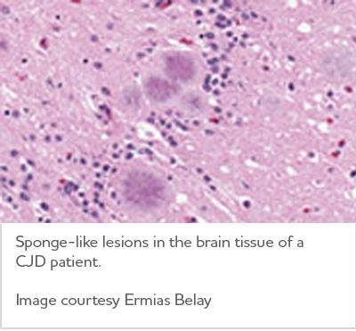 Sponge-like lesions in the brain tissue of a CJD patient.